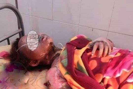 Chồng bạo hành rồi tẩm xăng thiêu sống vợ