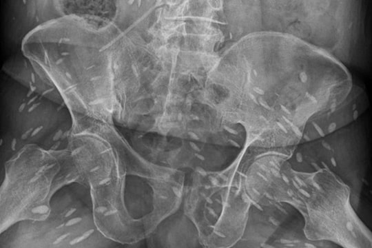 Trứng sán ký sinh dày đặc trong cơ thể người đàn ông 