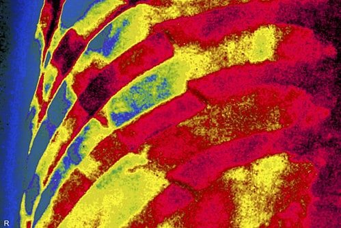 Người phụ nữ đầu tiên thế giới không có vitamin D trong cơ thể