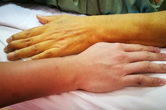 8 dấu hiệu cảnh báo bạn mắc bệnh gan