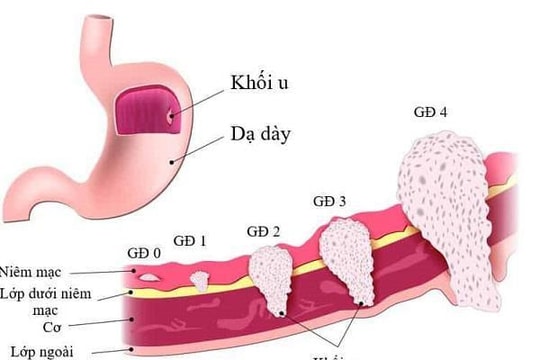 Người mẫu 8x qua đời ở tuổi 37 vì ung thư dạ dày, chuyên gia khuyến cáo gì?