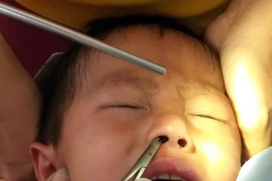 Tắm khe suối ngày lễ, người dân ở Nghệ An bị đỉa chui vào mũi