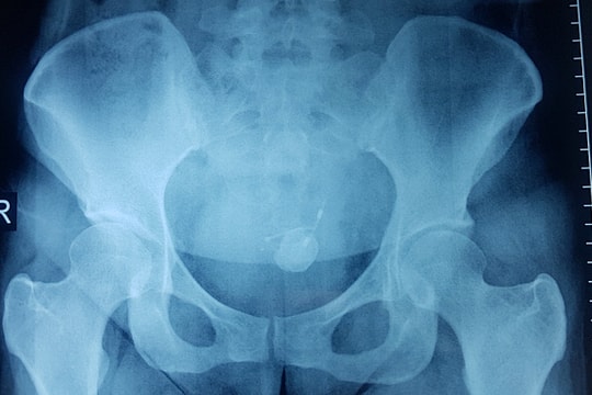 Vòng tránh thai đi lạc vào bàng quang