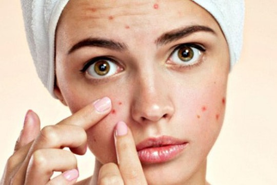 8 vị trí mụn mọc trên mặt cảnh báo vấn đề sức khỏe bạn nên lưu tâm
