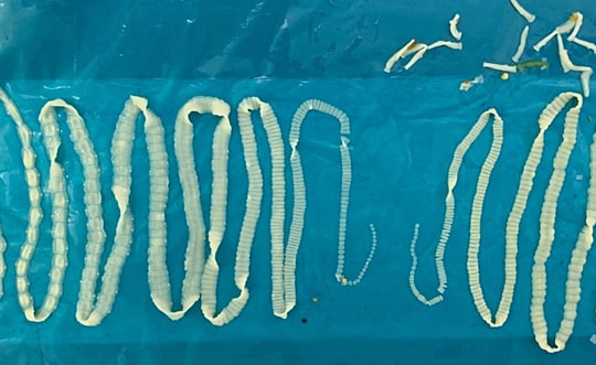 Cặp sán dây dài 2 m chui ra khỏi cơ thể người đàn ông