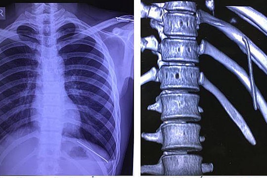Chiếc đinh tự di chuyển từ vai xuống phổi chàng trai 18 tuổi