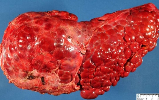 4 biểu hiện nhỏ trên cơ thể cảnh báo gan ngày càng yếu ớt, suy nhược