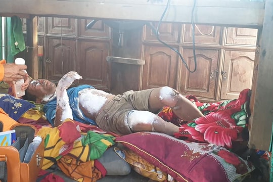 Cấp cứu thành công ngư dân Nghệ An bị bỏng nặng trên biển