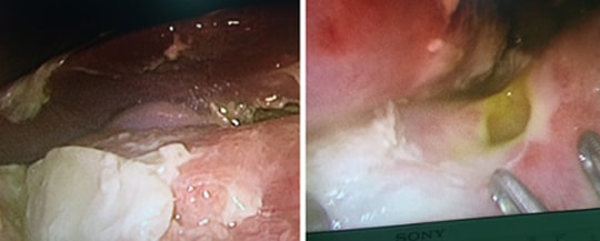 Con thủng dạ dày, tá tràng vì thói quen khi ăn của triệu gia đình Việt