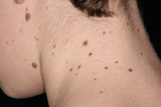 Mùa hè và nguy cơ ung thư hắc tố