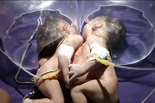 Cặp song sinh dính liền chung một trái tim