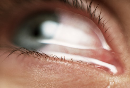 Nguyên nhân khiến bạn chảy nước mắt không kiểm soát