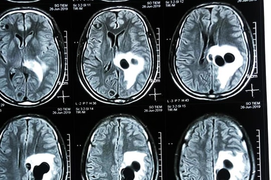 Ăn tiết canh, bệnh nhân bị sán làm tổ trong não