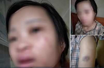 Đặt hàng qua mạng, người vợ mang thai ở Nghệ An bị chồng đánh thâm tím 