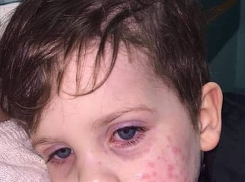 Bé trai 3 tuổi nhiễm virus bệnh tình dục sau nụ hôn vào má