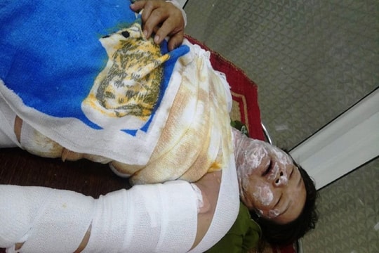 Mâu thuẫn sau chầu nhậu, chồng hờ tẩm xăng đốt vợ