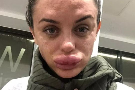 Cô gái môi sưng vù, suýt hoại tử vì tiêm filler 