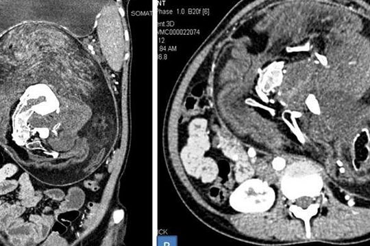 Mang song thai suốt 17 năm không hề hay biết