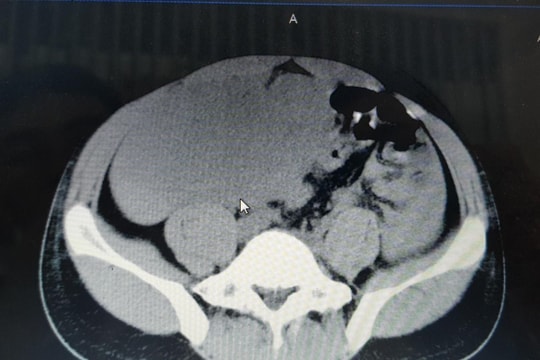 Bệnh viện Đa khoa thành phố Vinh phẫu thuật thành công cho bệnh nhân 29 tuổi mắc u mạc treo hiếm gặp