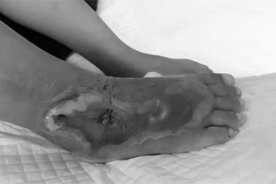 Bé gái 3 tuổi bị rắn hổ mang bò vào nhà cắn