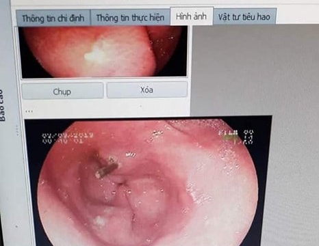 Bà cụ nuốt tăm tre dài 7 cm, bị đâm thủng dạ dày  