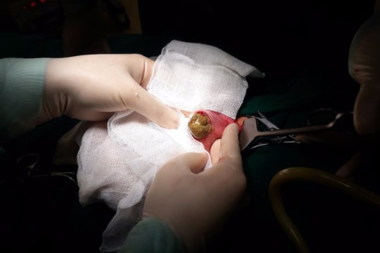 Do ăn nhiều măng và hồng, bé 6 tuổi phải mổ dạ dày cấp cứu 