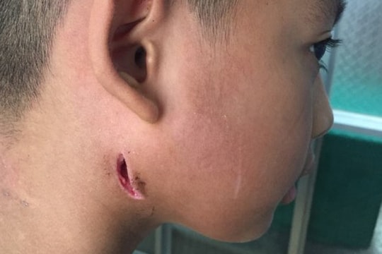 Bệnh Whitmore nguy hiểm như thế nào?