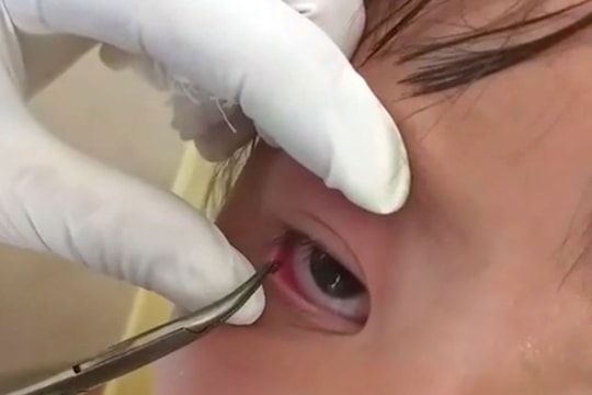 Khám mắt cho bé gái người Mông, bác sĩ phát hiện và gắp ra một con vắt 
