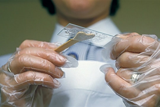 Những phương pháp phát hiện sớm ung thư tử cung