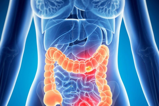 5 loại thực phẩm ăn nhiều dễ mắc ung thư ruột