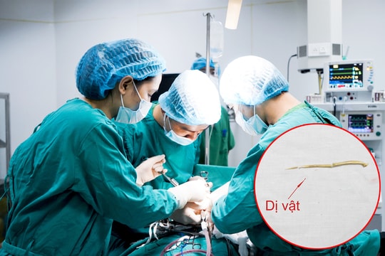 Người đàn ông có nguy cơ bị thủng ruột do nuốt phải tăm