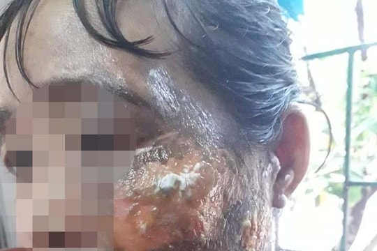 Căm phẫn người chồng hắt nước sôi vào mặt vợ ở Nghệ An