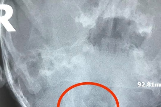 Bé 13 tháng tuổi ở Nghệ An nuốt phải mảnh thép sau khi ăn cháo mua sẵn