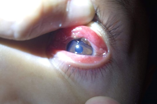 Gắp con vắt sống dài 2cm trong mắt bệnh nhi 8 tuổi ở Nghệ An