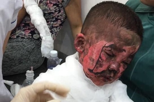 Nghịch bật lửa đốt giấy gây cháy, hai cháu bé ở Nghệ An bị bỏng nặng