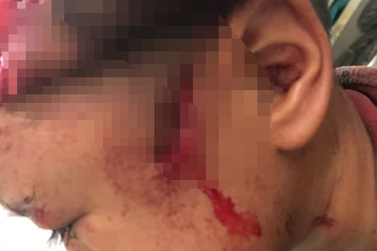 Bé trai ở Nghệ An bị chó nhà cắn toác nửa da đầu