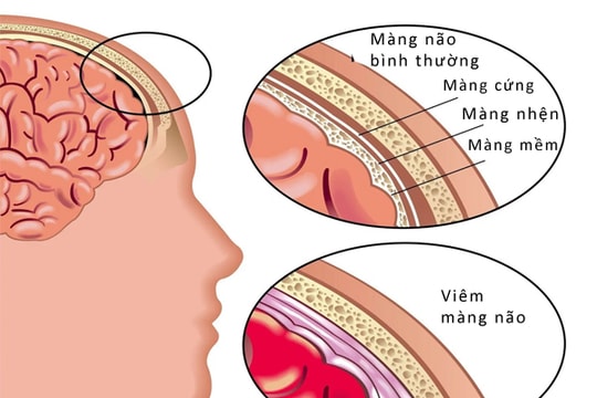 Căn bệnh viêm màng não nguy hiểm như thế nào?