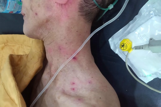 2 bố con ở Nghệ An bị ong đốt hàng trăm nốt