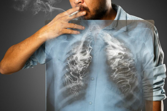 Hút thuốc lá gây nhiều bệnh nguy hiểm về phổi