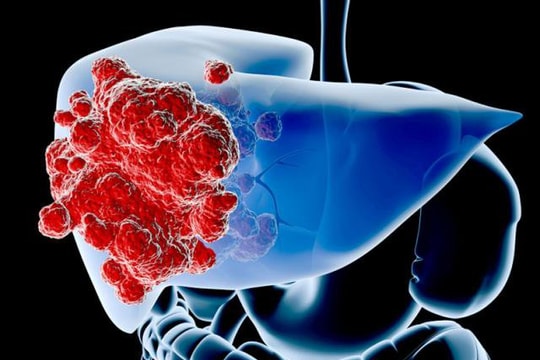Ung thư gan dẫn đầu các bệnh ung thư ở Việt Nam