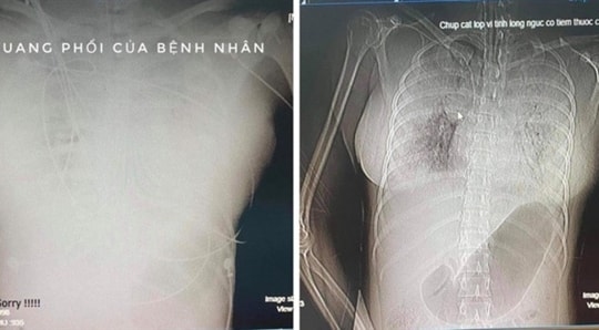 Người phụ nữ 32 tuổi tử vong sau khi tiêm nâng ngực