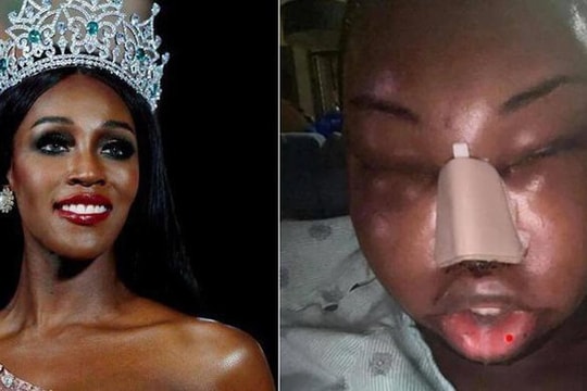 Sốc với khuôn mặt biến dạng vì thẩm mỹ của Hoa hậu chuyển giới quốc tế 2019