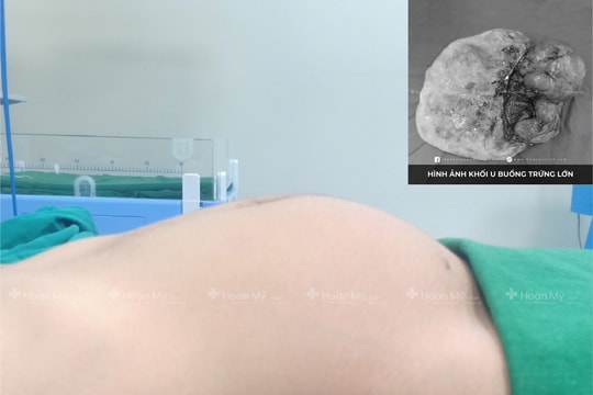 Khối u to như trái bóng liên tiếp mọc trong cơ thể cô gái 22 tuổi