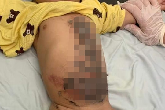 Cấp cứu cho trẻ bị bỏng được thầy lang sơ cứu bằng cách đắp lông chó vào vết thương