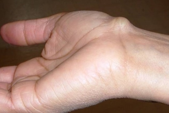 Các dấu hiệu ở tay cảnh báo tim bất ổn