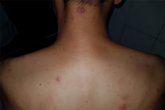 Việt Nam muốn xóa sổ bệnh phong cùi