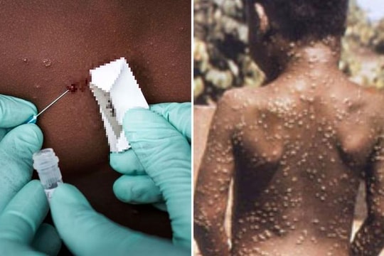 WHO đánh giá nguy cơ của bệnh đậu mùa khỉ