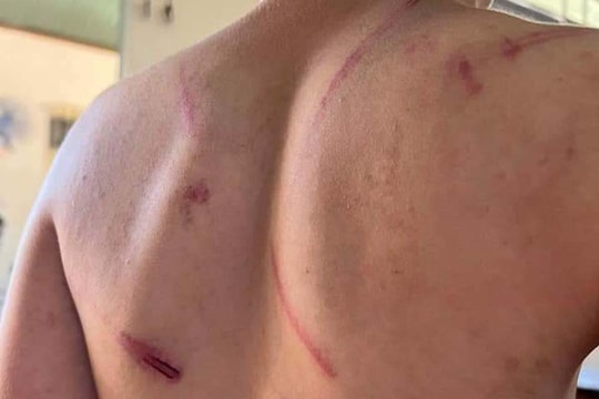 Bé 9 tuổi bị bố và bà nội bạo hành