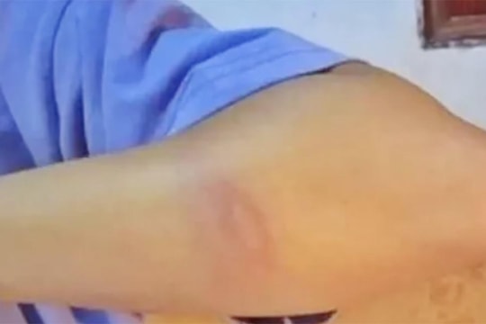 Nam giáo viên bị tố đánh bầm tím nữ sinh lớp 7 ở Nghệ An lên tiếng