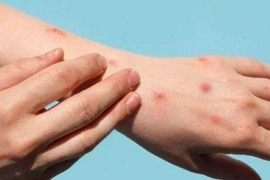 Đậu mùa khỉ có phải là bệnh lây truyền qua đường tình dục?